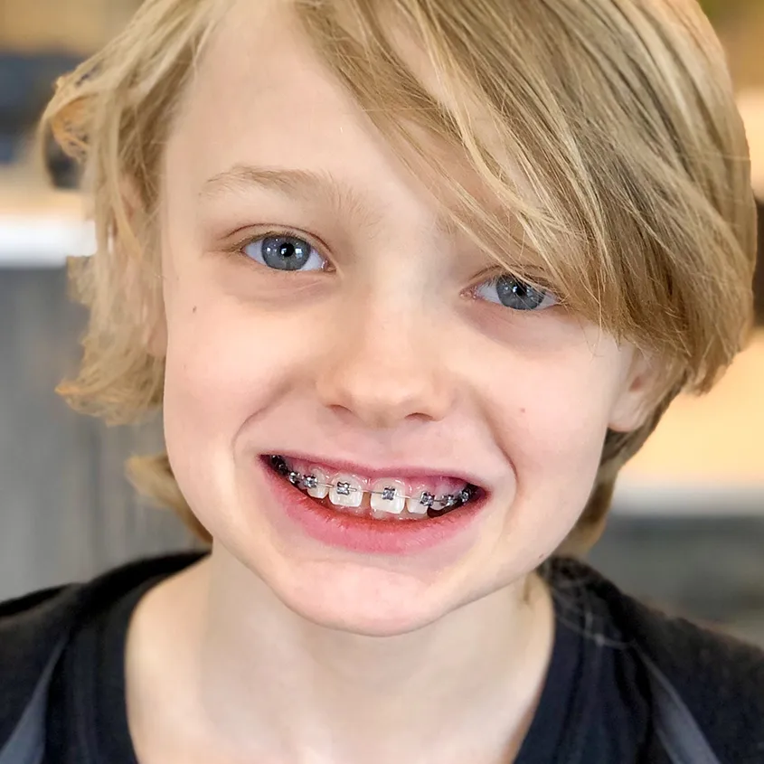 chłopiec leczony aparatem stałym -skierniewice ortodonta
